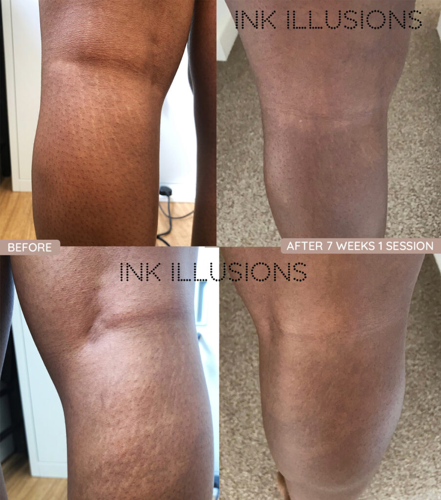 inkless tattooing stretch marks london essex before after