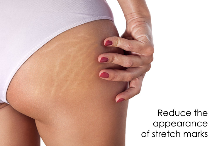 reduce stretch marks with tattooing
