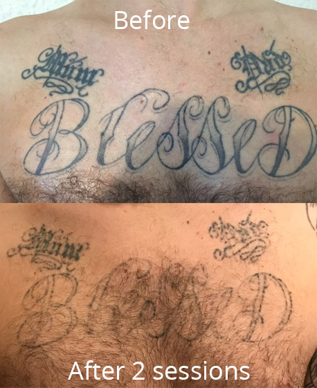 2 sessions spaced 4 months apart After photo taken one year after 2nd  session Q switch nanosecond laser  rTattooRemoval