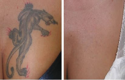 Laser Tattoo Removal London & Essex Ink Illusions