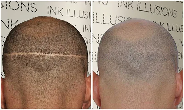 head scalp scar camouflage before after