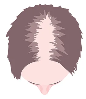 women alopecia hair loss tattooing