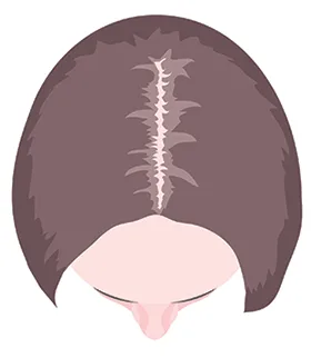 women hair loss receding parting and hairline