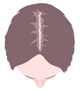 women hair loss receding parting