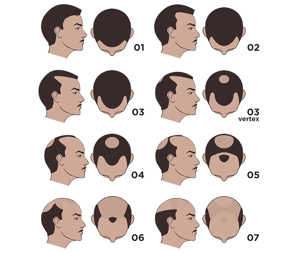 completely bald head tattooing micropigmentation