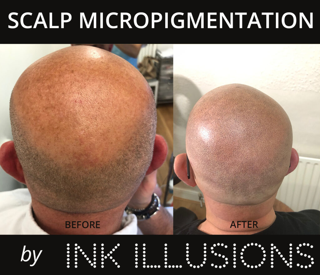 Scalp Micropigmentation (SMP) Ink Illusions