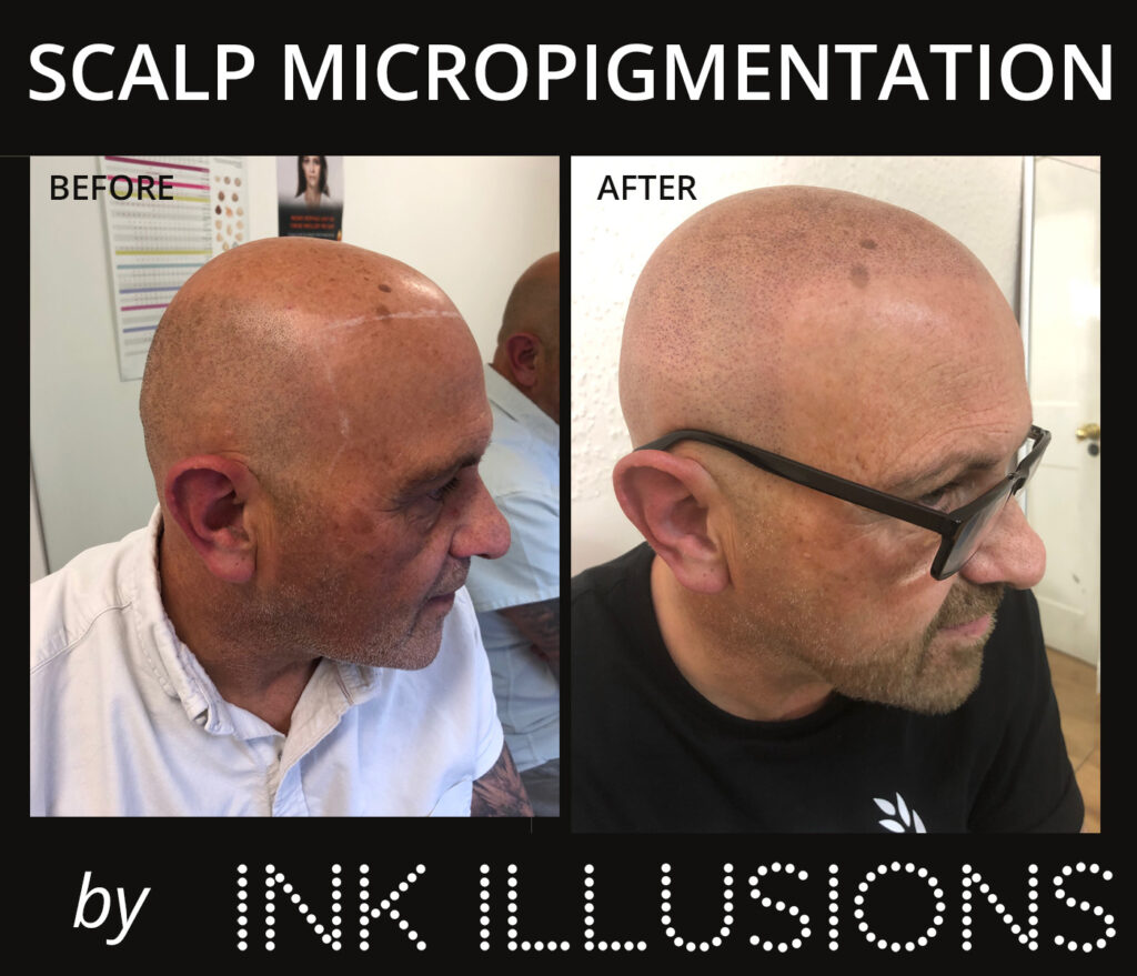 Scalp Micropigmentation (SMP) Ink Illusions