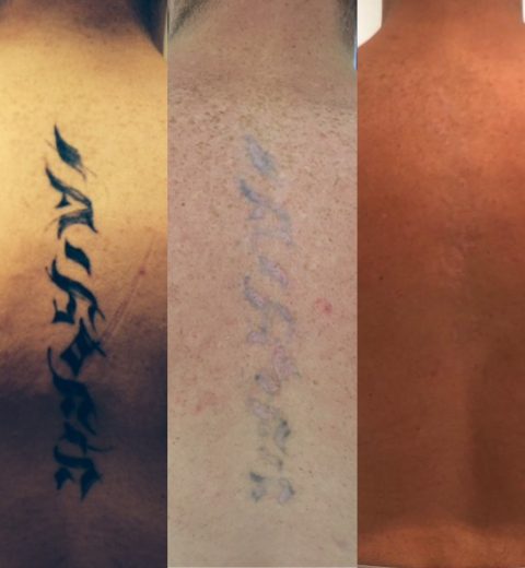 before after laser tattoo removal hertfordshire