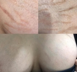 breast stretch marks camouflage