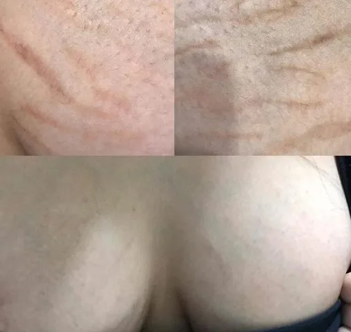 breast stretch marks camouflage breast stretch marks camouflage