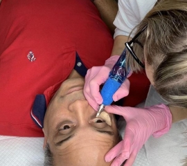 dark eye bag treatment in progress
