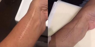 wrist scar camouflage with tattooing