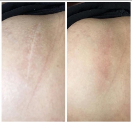 scar camouflage with tattoo ink