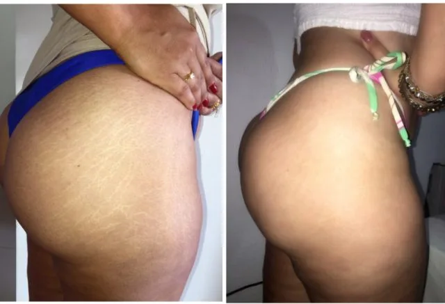bum stretch mark camouflage tattoo bum stretch mark camouflage tattoo