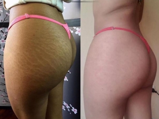 Image credit Novique Studio, Sweden - stretch mark camouflage by skin tone tattoo ink