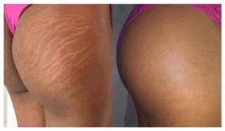 bottom stretch mark removal with tattoo ink