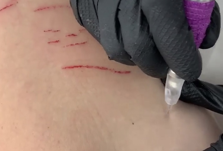 MCA Needling (dry) Tattooing Scar Treatment Ink Illusions