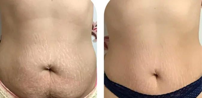 stretch mark tattoo cover up stomach