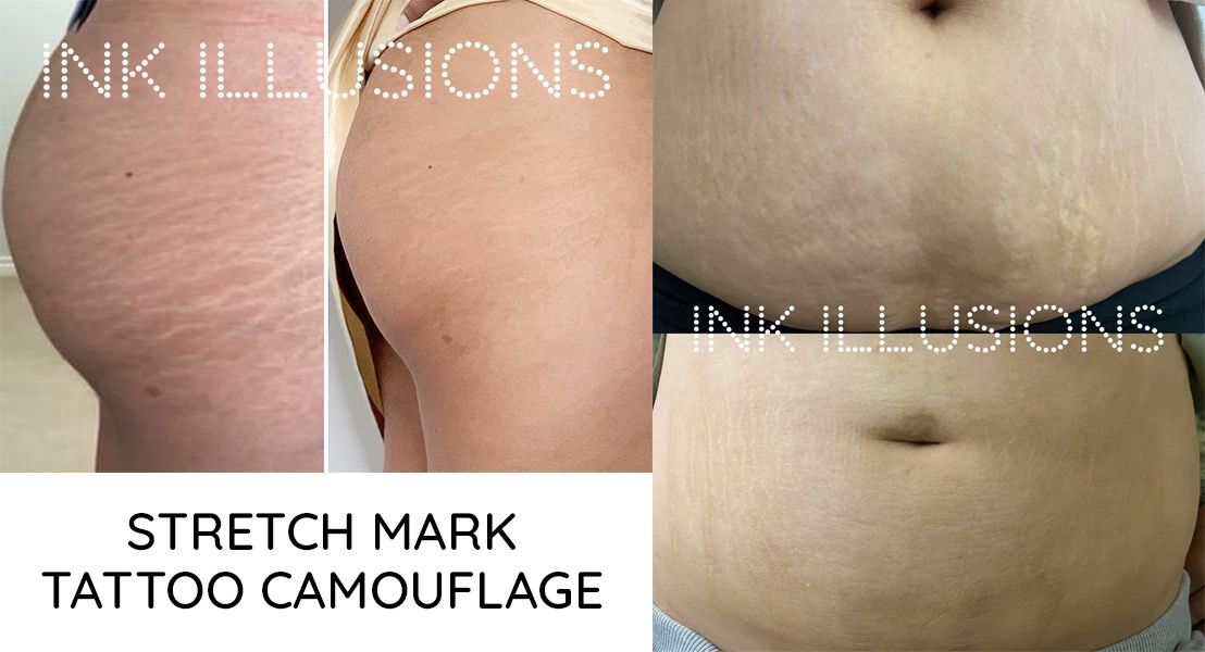 As a permanent makeup artist, should I tattoo stretch marks? - Ink Illusions