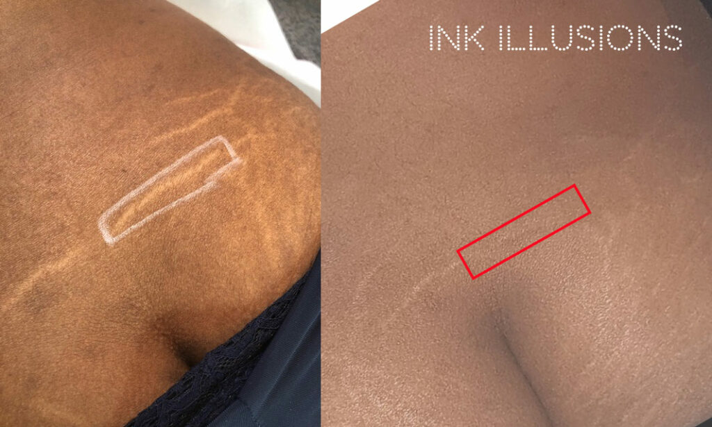 What is MCA Dry Needling? Ink Illusions