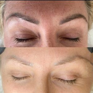 Laser Removal of Permanent Makeup  TANIA BHANGOO PERMANENT MAKEUP