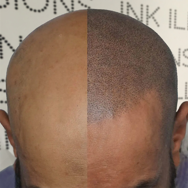 What is Scalp Micropigmentation? Ink Illusions