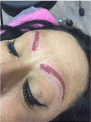 Emergency 48 hour Eyebrow Tattoo / Microblading Removal Ink Illusions