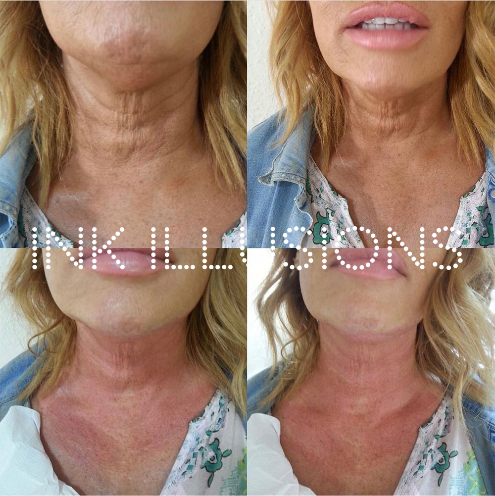 Collagen Induction Therapy - Inkless MCA needling, Microneedling, Dermaroller Ink Illusions