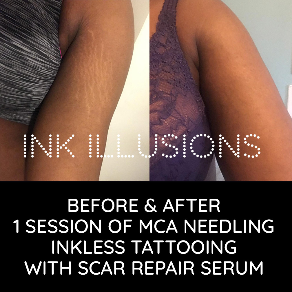 Inkless Stretch Mark and Scar Tattoo Camouflage Treatment Ink Illusions