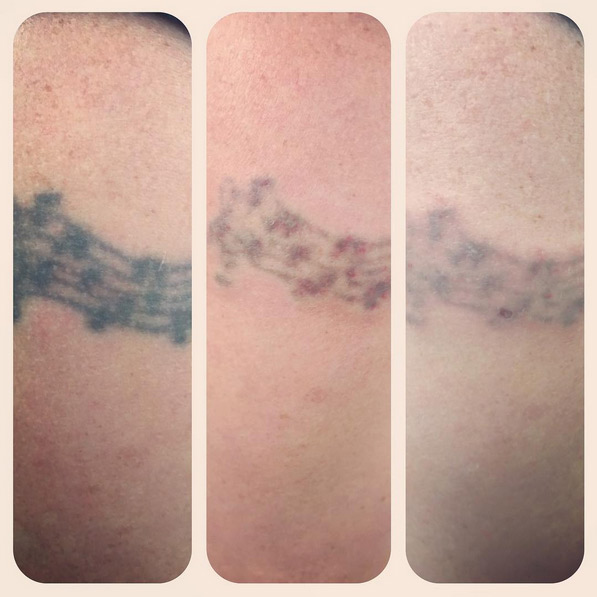 Laser tattoo removal Brentwood Essex - Ink Illusions