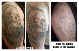 How Many Sessions to Remove My Tattoo Everything You Need to Know About  Laser Tattoo Removal