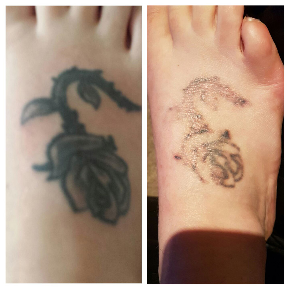 Laser tattoo removal Brentwood Essex Ink Illusions