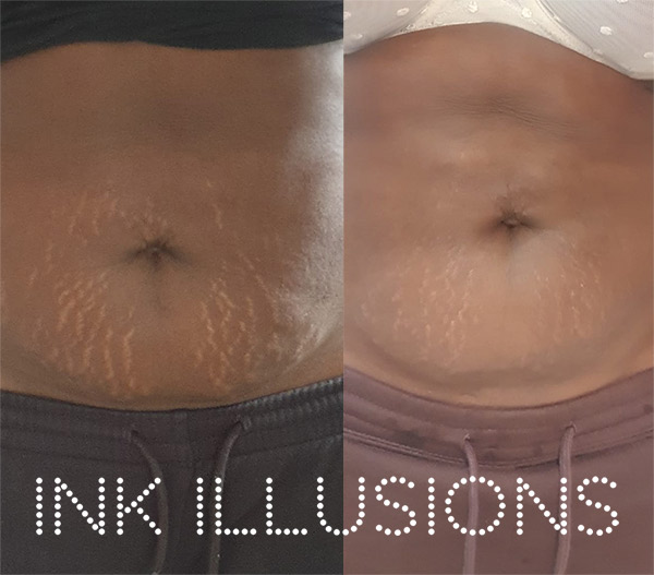 Stretch mark camouflage tattoo Brentwood Essex Ink Illusions
