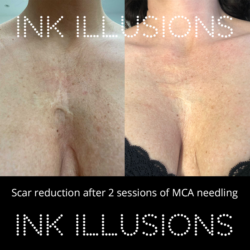 What is the inkless stretch mark removal camouflage treatment? Ink Illusions