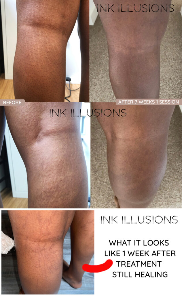 What is the inkless stretch mark removal camouflage treatment? Ink Illusions