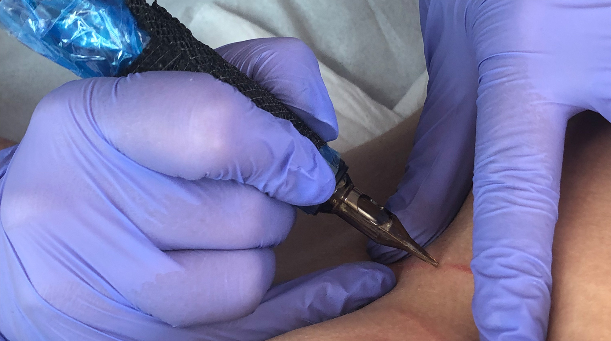 MCA inkless needling skin close up