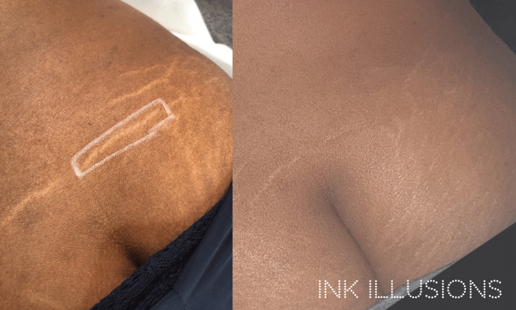 inkless stretch mark tattoo technique