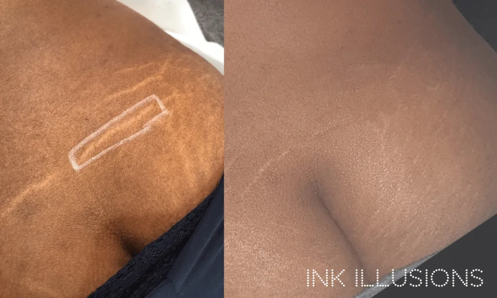 inkless stretch mark tattoo technique