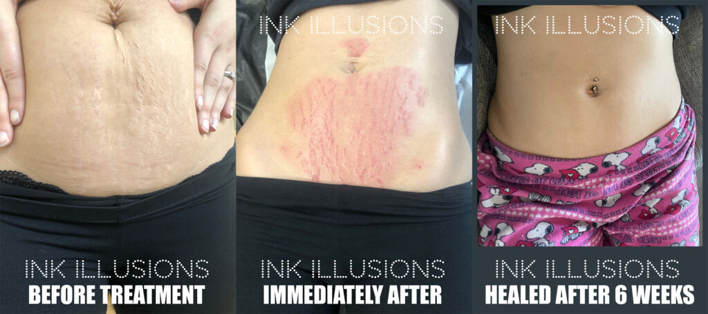 stretch mark removal inkless technique