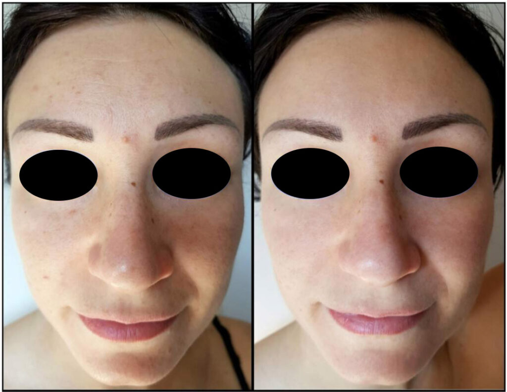 TCA Medium Depth Face & Body Peels with BioRePeelCl3 Ink Illusions