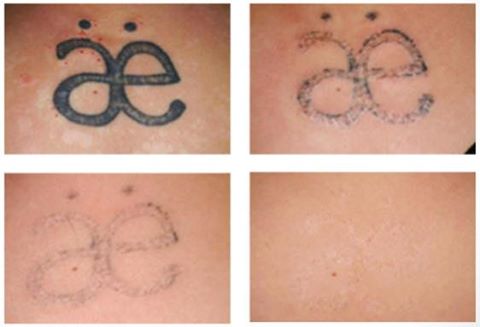 Laser tattoo removal in London