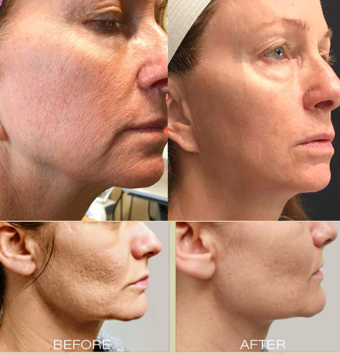 Radiofrequency RF Combined Microneedling Skin Tightening Treatment Ink Illusions