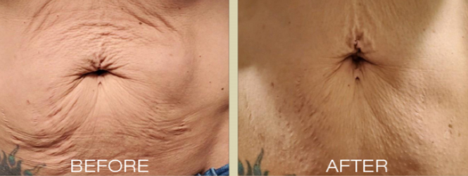 Radiofrequency RF Combined Microneedling Skin Tightening Treatment Ink Illusions