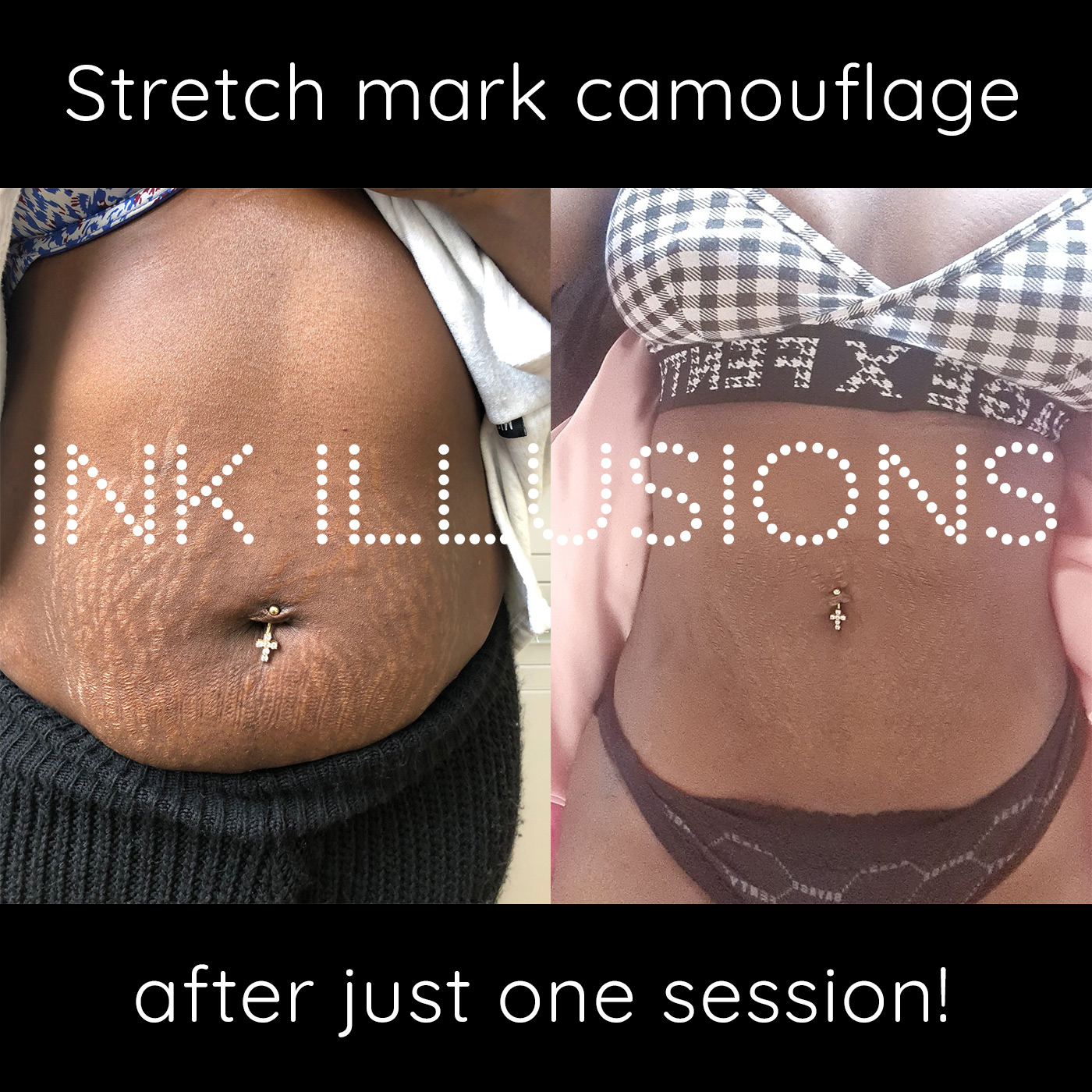 Why darker skin types usually don’t need ink for stretch mark camouflage Ink Illusions