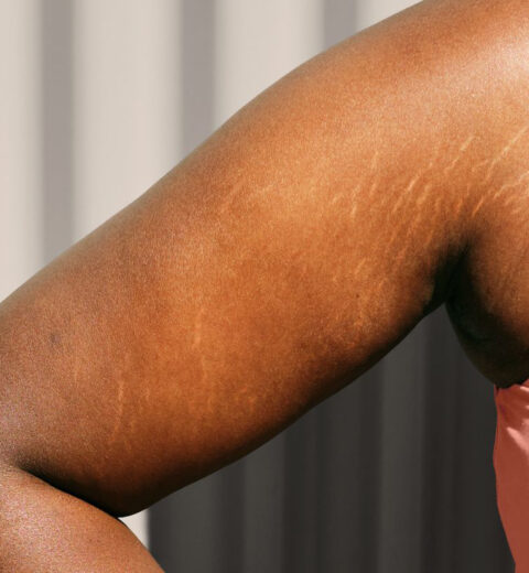 tattoing stretch marks on darler skin types