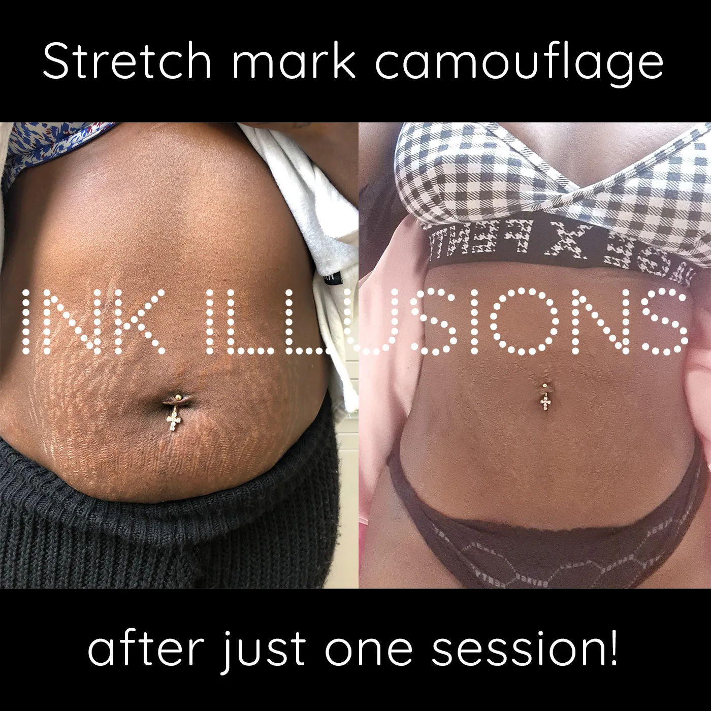 stomach tummy stretch marks treatment