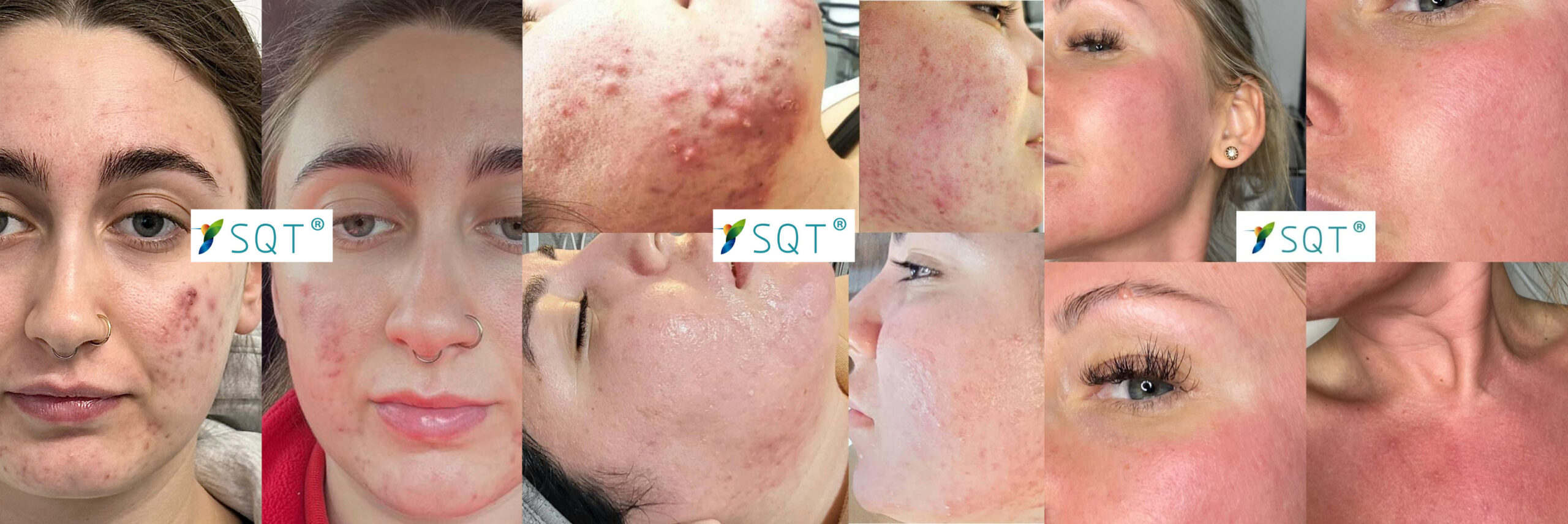 SQT Bio-microneedling revolutionary anti-aging acne peel treatment Ink Illusions