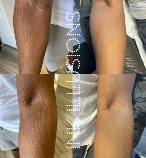 MCA micro needling stretch marks