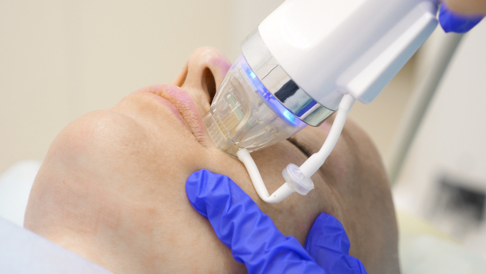 Radiofrequency (RF) Microneedling Training Course Online + Classroom Ink Illusions