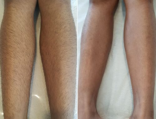 laser and IPL hair removal ink illusions